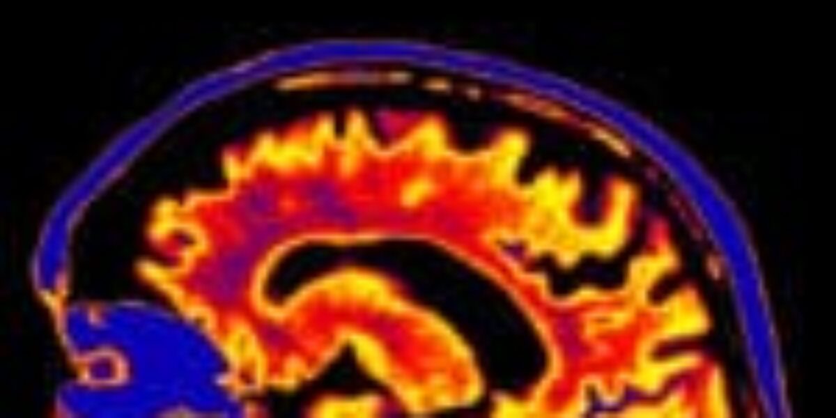 Hidden Protein May Explain Why Some Relatives Avoid a Devastating Seizure Disorder