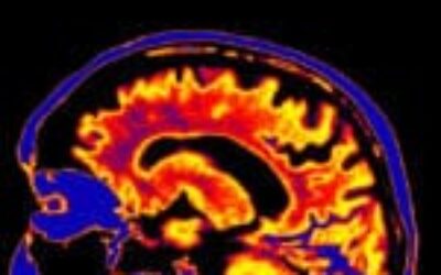 Hidden Protein May Explain Why Some Relatives Avoid a Devastating Seizure Disorder