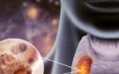 The Quiet Rise of Thyroid Cancer Among Younger Women