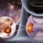 The Quiet Rise of Thyroid Cancer Among Younger Women