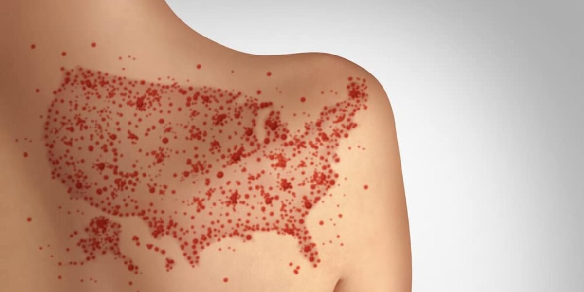 Canada Loses Measles-Free Status After Nearly 30 Years as the U.S. Faces Growing Risk
