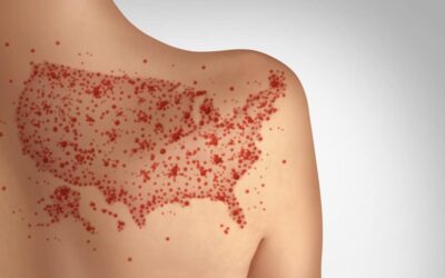 Canada Loses Measles-Free Status After Nearly 30 Years as the U.S. Faces Growing Risk