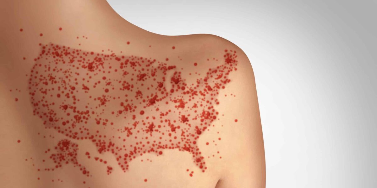 Health Officials Issue Warning After Measles Detected at Two Major US Airports
