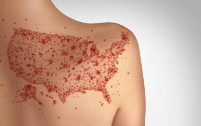 Health Officials Issue Warning After Measles Detected at Two Major US Airports